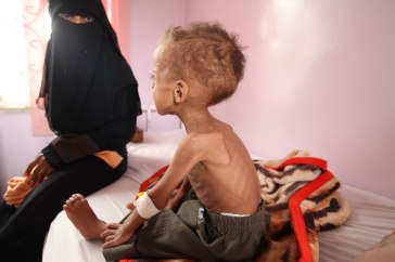 Faisal, 18 months old is treated for severe acute malnutrition at Sabeen hospital in Yemen’s capital Sana’a. | Photo: UNICEF/UMI191723/Yasin